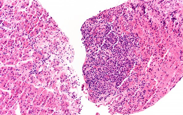 6B2 IgG4 Disease Adenohypophysis (Case 6) B2 H&E 20X