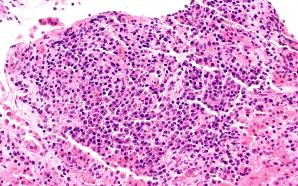 6B3 IgG4 Disease Adenohypophysis (Case 6) B2 H&E 40X