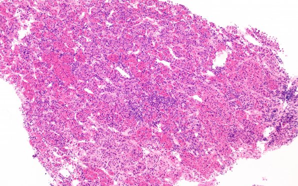 6B4  IgG4 Disease Adenohypophysis (Case 6) B3 H&E 10X