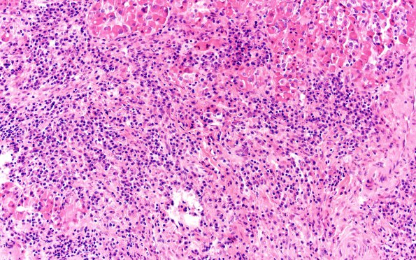 6B5 IgG4 Disease Adenohypophysis (Case 6) A2 H&E 20X