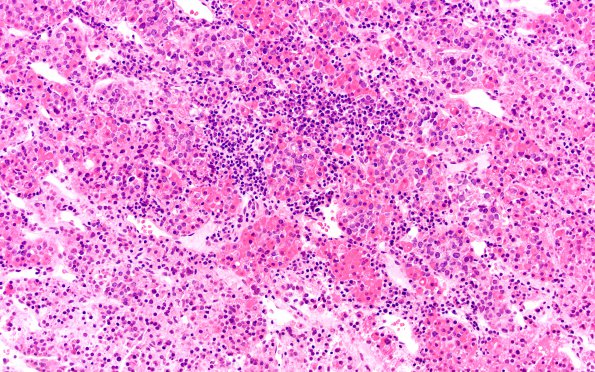 6B6 IgG4 Disease Adenohypophysis (Case 6) B3 H&E 20X