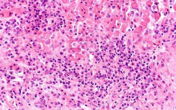 6B7 IgG4 Disease Adenohypophysis (Case 6) A2 H&E 40X