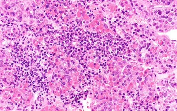 6B8 IgG4 Disease Adenohypophysis (Case 6) B3 H&E 40X