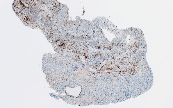 6C1 IgG4 Disease Adenohypophysis (Case 6) A2 CD3 4X