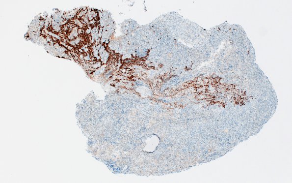 6E1 IgG4 Disease Adenohypophysis (Case 6) A2 CD138 4X