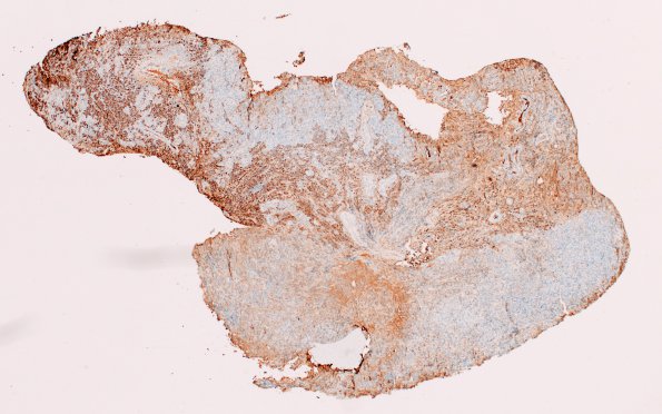 6F1 IgG4 Disease Adenohypophysis (Case 6) A2 IgG 4X