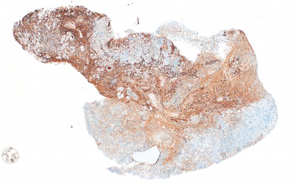 6G1 IgG4 Disease Adenohypophysis (Case 6) A2 IgG4 4X