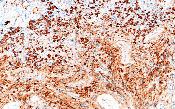 6G3 IgG4 Disease Adenohypophysis (Case 6) A2 IgG4 20X