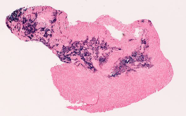 6H1 IgG4 Disease Adenohypophysis (Case 6) A2 ISH Kappa 4X