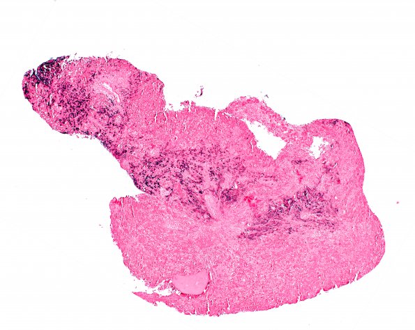 6H2 IgG4 Disease Adenohypophysis (Case 6) A2 ISH Lambda 4X