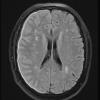 7A1 IgG4 disease (Case 7) FLAIR - Copy