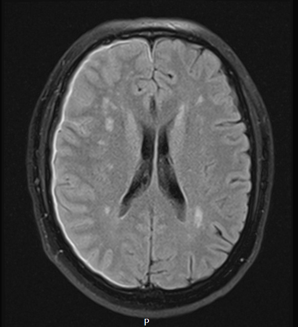 7A1 IgG4 disease (Case 7) FLAIR - Copy