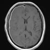 7A3 IgG4 disease (Case 7) T1W - Copy