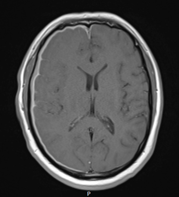 7A3 IgG4 disease (Case 7) T1W - Copy