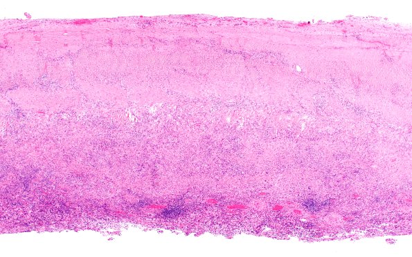 7B1 IgG4 disease (Case 7) H&E H&E 4X