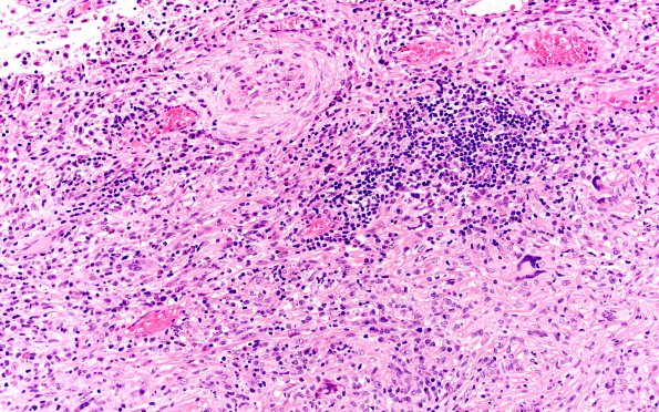 7B2 IgG4 disease (Case 7) H&E 20X 3