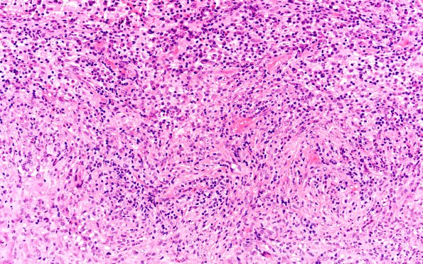 7B3 IgG4 disease (Case 7) H&E 20X