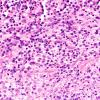 7B4 IgG4 disease (Case 7) H&E 40X