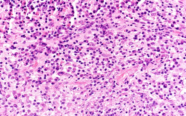 7B4 IgG4 disease (Case 7) H&E 40X