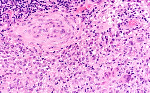 7B5 IgG4 disease (Case 7) H&E 40X 2