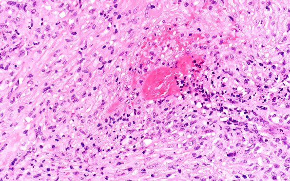 7B6 IgG4 disease (Case 7) SMA 40X 1