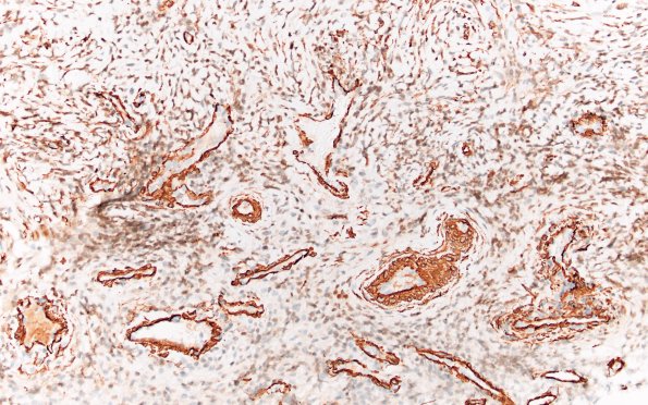 7C1 IgG4 disease (Case 7) SMA 20X 2