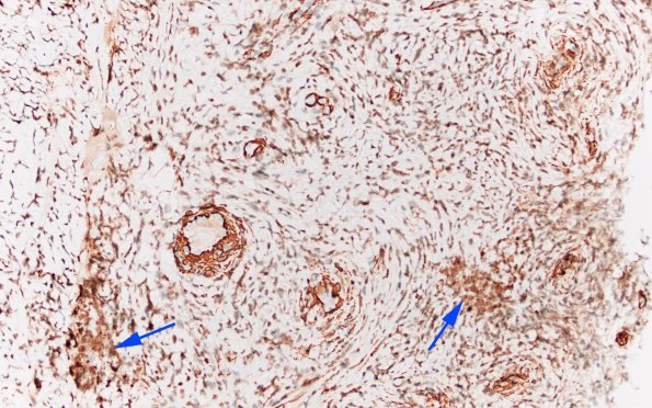 7C2 IgG4 disease (Case 7) SMA 20X 3 copy