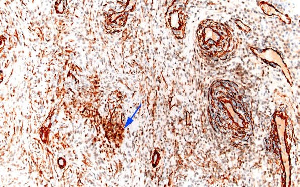 7C3 IgG4 disease (Case 7) SMA 20X 5 copy