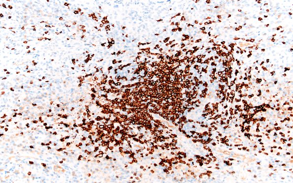 7D4 IgG4 disease (Case 7) CD20 20X