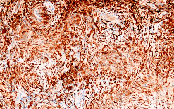 7D6 IgG4 disease (Case 7) CD163 20X