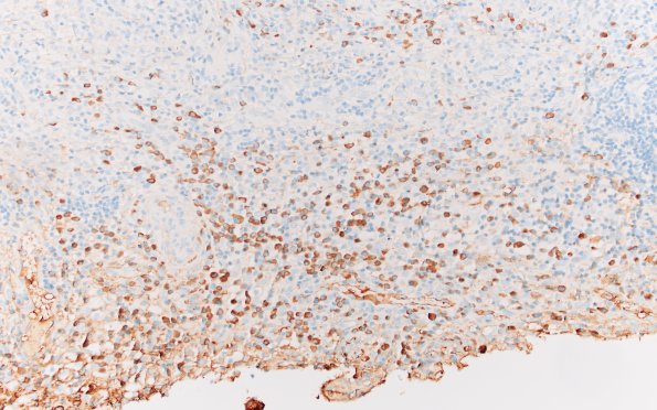 7F1 IgG4 disease (Case 7) IgG 20X