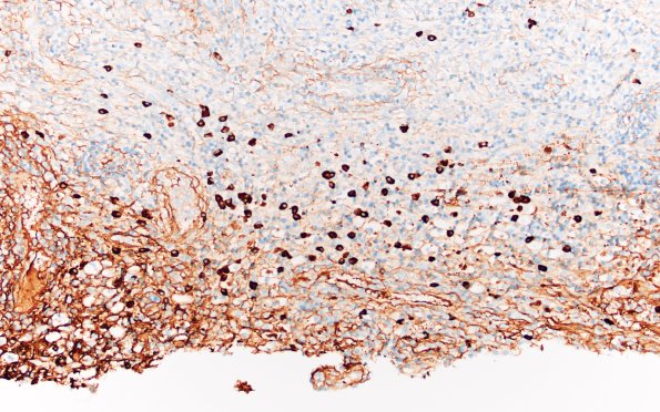 7F2 IgG4 disease (Case 7) IgG4 20X