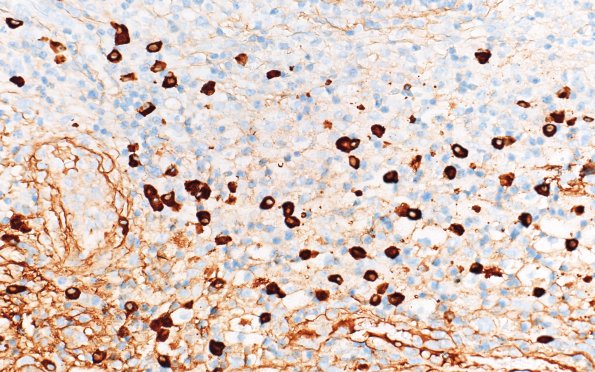 7F3 IgG4 disease (Case 7) IgG4 40X