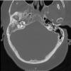 8A1 Brain (Case 8) (9-11) Temporal Bone A - Copy