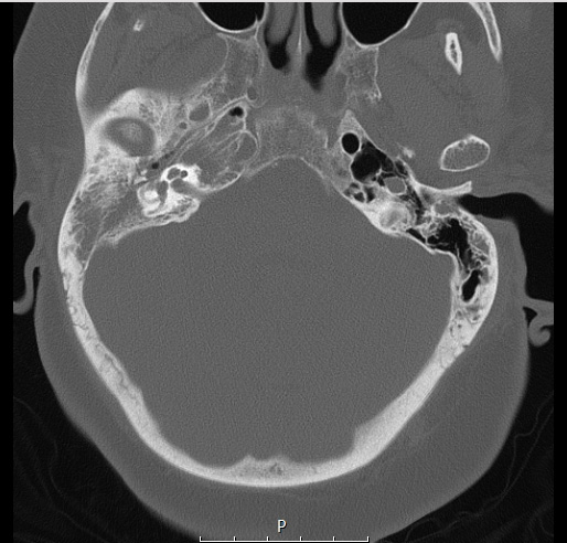 8A1 Brain (Case 8) (9-11) Temporal Bone A - Copy