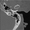 8A2 Brain (Case 8) (9-11) Temporal Bone L A - Copy