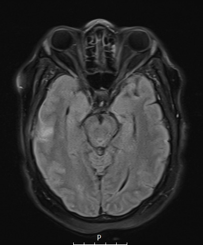 8D1 Brain (Case 8) (9-9) T2 FLAIR A - Copy