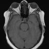 8D2 Brain (Case 8) (9-9) T1noC A - Copy