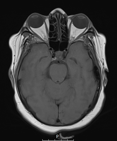 8D2 Brain (Case 8) (9-9) T1noC A - Copy