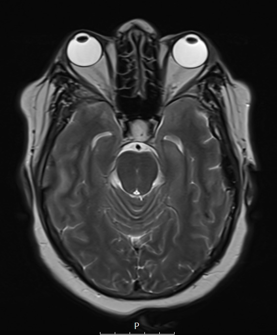 8D3 Brain (Case 8) (9-9) T2 2 A - Copy