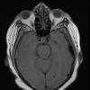 8D5 Brain (Case 8) (10-3) T1W A - Copy