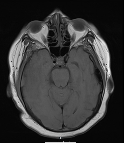 8D5 Brain (Case 8) (10-3) T1W A - Copy