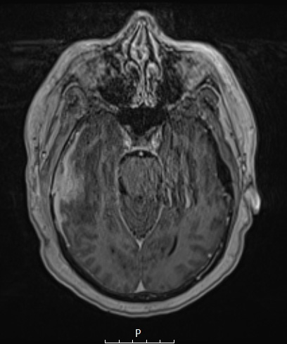 8D6 Brain (Case 8) (10-3) MP RAGE W A - Copy