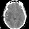 8D7 Brain (Case 8)  (10-5) Bone 5A - Copy