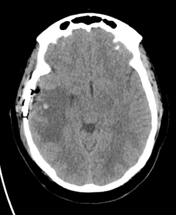 8D7 Brain (Case 8)  (10-5) Bone 5A - Copy