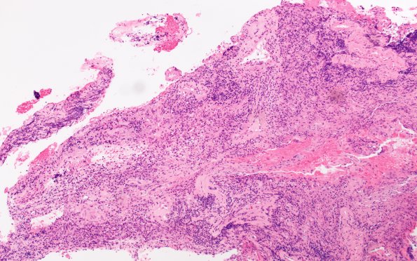 8E1 Brain (Case 8) A2 H&E 10X 1