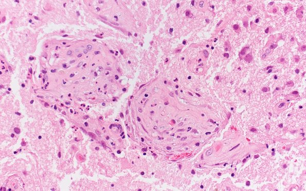 8E6 Brain (Case 8) A2 H&E 40X 3