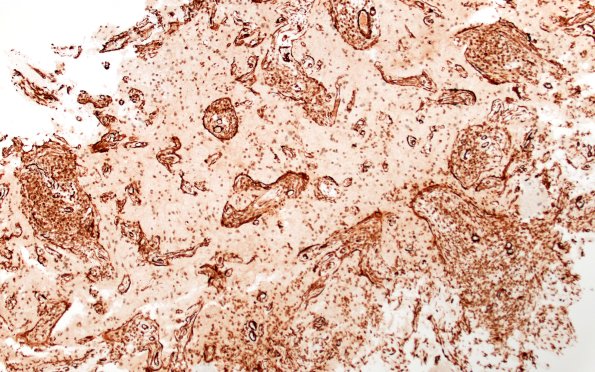 8G1 Brain (Case 8) A2 SMA 10X 1