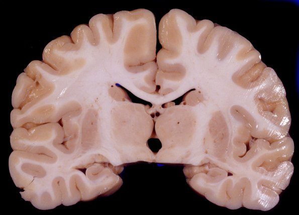 1A10 Normal Brain 3