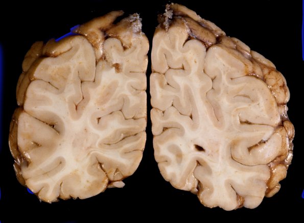 1A12 Brain, coronal, Section 10